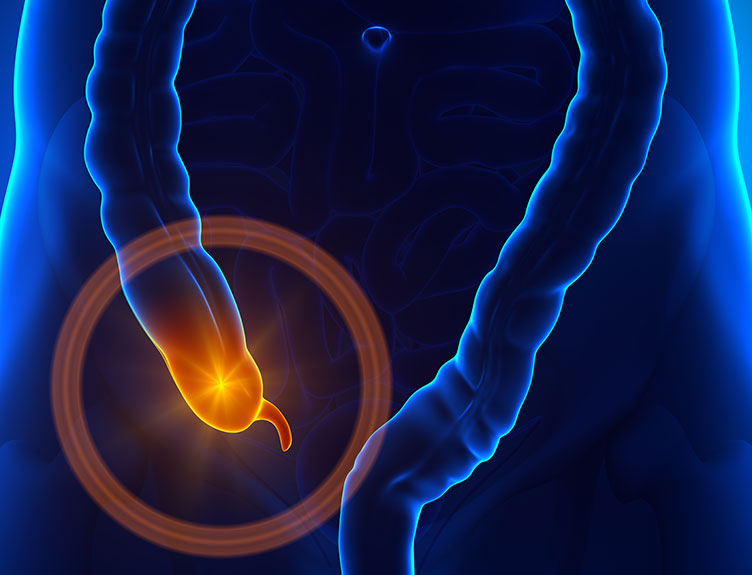 Illustration of abdomen with appendix highlighted