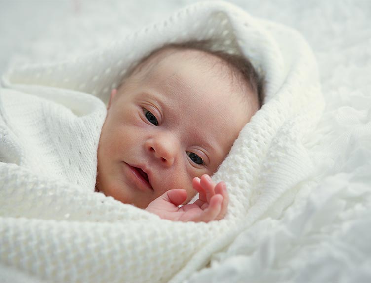 Baby with Down Syndrome