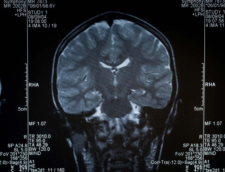 MRI MRI